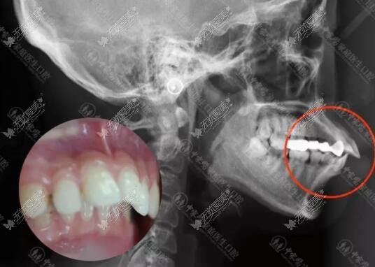 我骨性龅牙内收7毫米前后对比图片正畸正颌后嘴型变化挺大