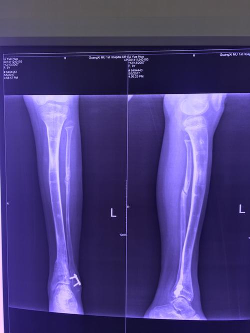 踝上截骨矫形,腓骨分期两处截断手术设计左踝内翻畸形,2岁,胫骨远端