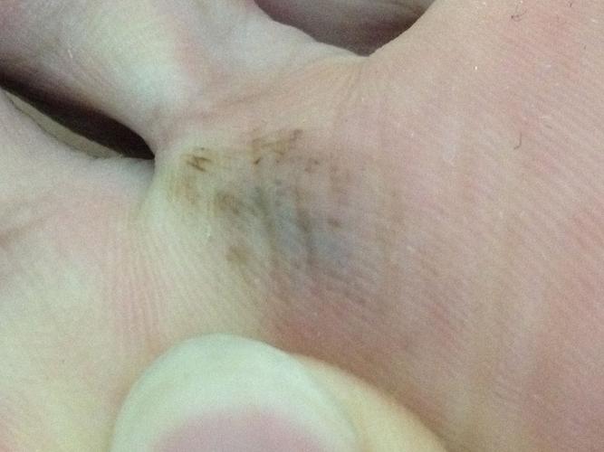 请问这个脚底的黑斑是恶性黑色素瘤吗,出生就有的,是胎记吗?
