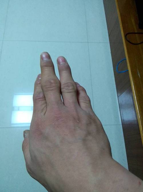 手指关节大,是以前打篮球骨折的,后来又掰.现在特难看.