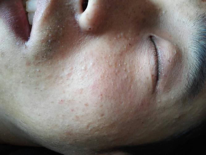 全脸散在皮色丘疹,类似闭合性粉刺,但没有内容物,右侧眉毛外侧有一