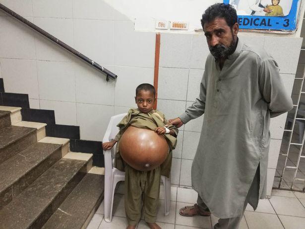 【奇难杂症】巴基斯坦男孩患罕见疾病,腹部胀至如同沙滩球的大小.