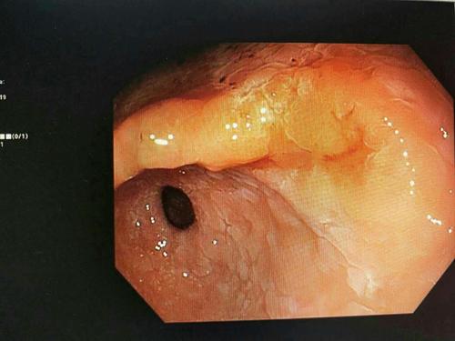 内镜白光下发现的早期胃癌
