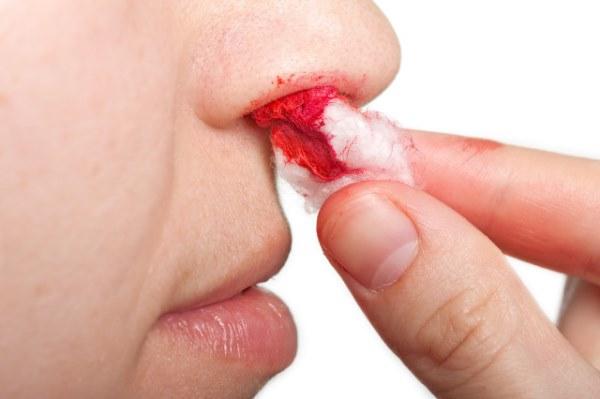 鼻子经常出血的诱因有哪些鼻腔内出血以后要如何处理