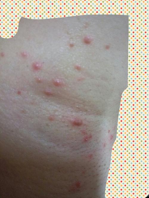 在胳肢窝处,红红的颗粒疙瘩状,不是很痒,这几天才起的是丘疹还是红疹