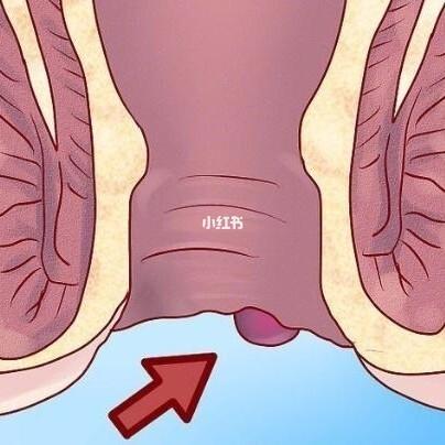 郑州丰益肛肠医院:肛门内口处有一个硬硬的圆球是怎么回事 发现肛门