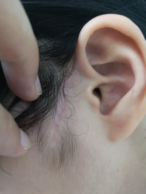 先天性耳前瘘管感染期手术与非感染期手术对比_先天性耳前瘘管_先天性