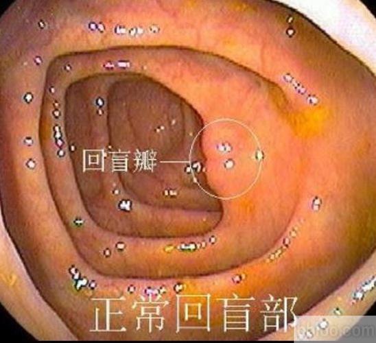回盲部包括盲肠和回盲瓣,是回盲瓣及其两侧延伸出的半月状皱襞以下的