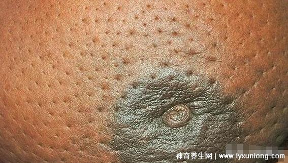 乳腺癌橘子皮样的褶皱图片