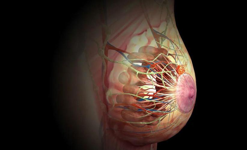 很多乳腺癌没有症状,一发现就是晚期!