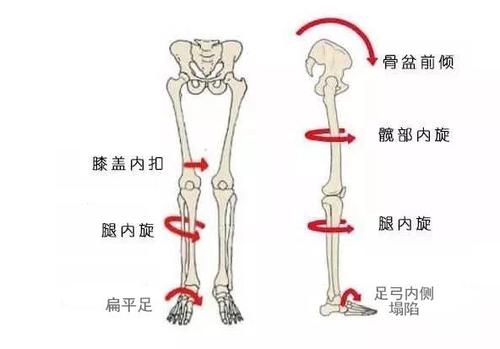 或者双腿随着股骨内旋,脚尖向内扣,成为内八字脚.