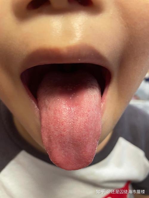 舌头上很多小泡