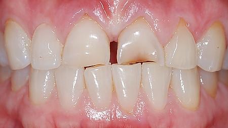 如果是长期的夜间磨牙, 会造成牙齿的磨耗, 使得牙齿变得又平又短.