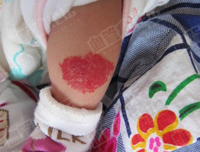 小宝宝腿部草莓状血管瘤病例