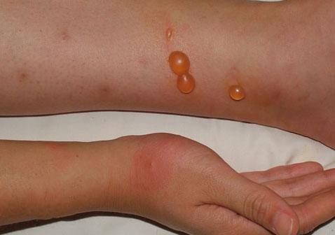 什么是丘疹性荨麻疹起水泡怎么办图片