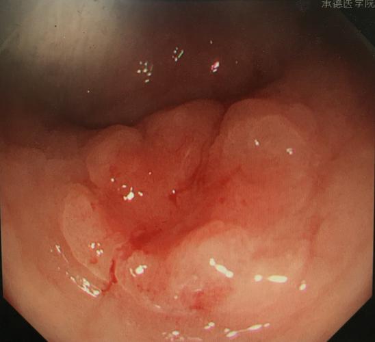 胃窦高级别异型增生(癌前病变2例)