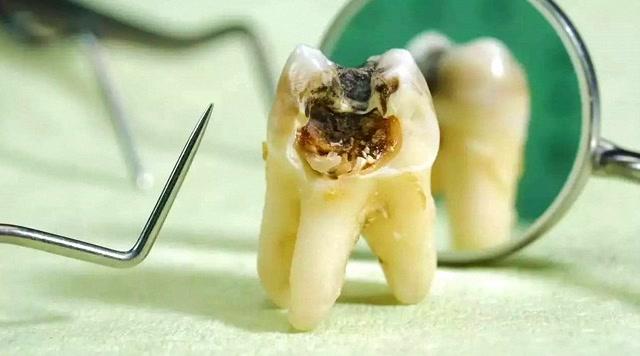 平时长的蛀牙,真的是有虫子在牙齿里面吗?今天总算知道了