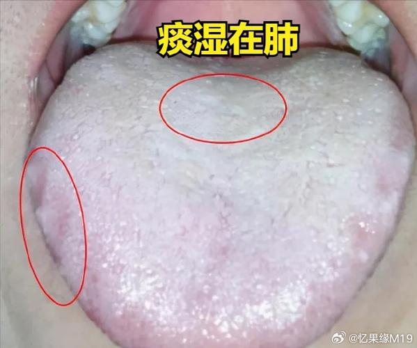 适用于痰湿在脾的人群    舌象:舌苔白厚腻,舌边齿痕    症状:体型