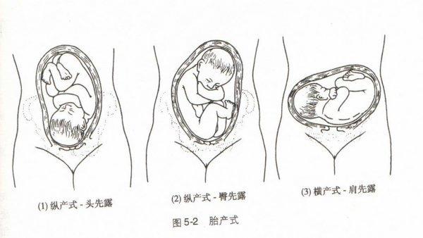 【分娩方式】产前就是孩子头部先入骨盆,这是顺产的最好的姿势,可以说