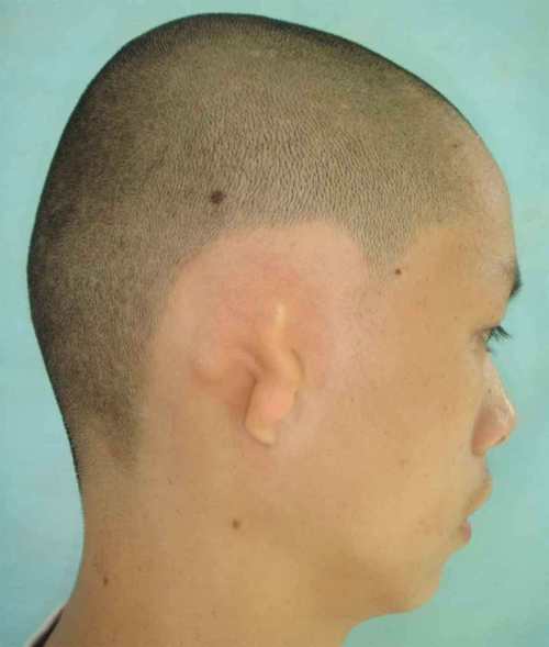 外耳二科典型病例四