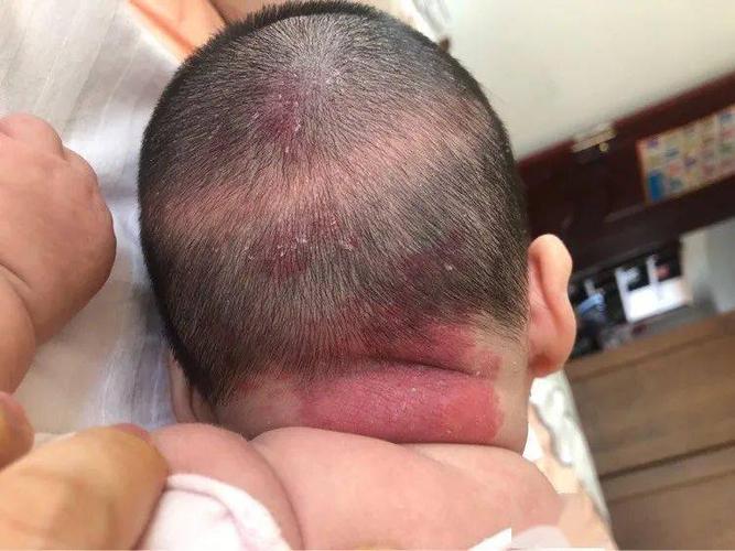 快检查宝宝脸上有没有这种疹子14种皮肤病再不懂辨别就会越治越糟糕