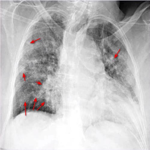 再讲讲胸片里面的肺纹理增粗和斑片影