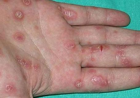 梅毒初期症状皮疹图片 梅毒一开始的征兆图片