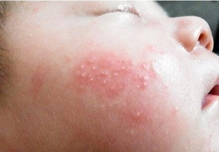 一个月宝宝脸有湿疹怎么能好 ( 一个月婴儿脸部湿疹怎么办)