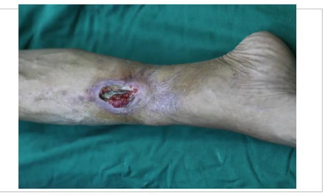 创面修复骨髓炎患者痊愈出院78岁老人腿部反复溃烂久治不愈只因7岁