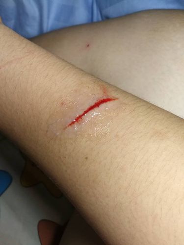 被钉子划了个长的伤口,但是伤口不深流血挺多,周围有点肿,需要打