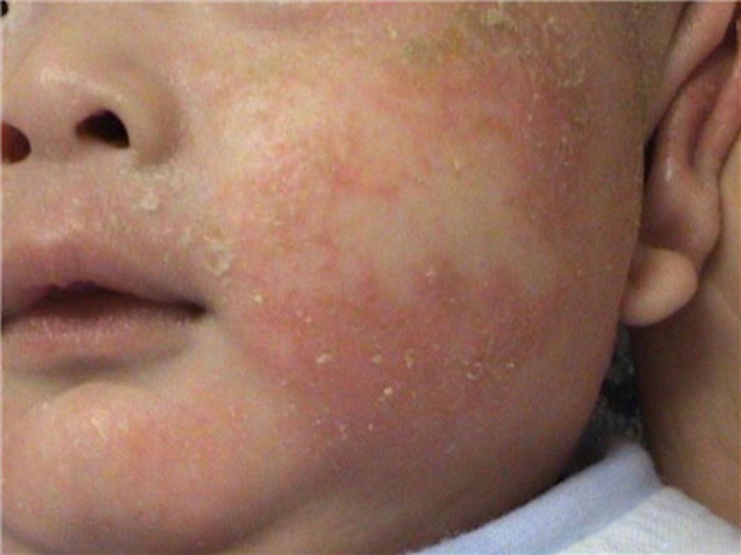 1,婴儿湿疹是怎么引起的 1内因 1遗传过敏性体质一般父母或家族中有