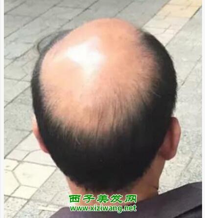 中间秃顶男士流行发型图片来看看秃顶发型如何扎