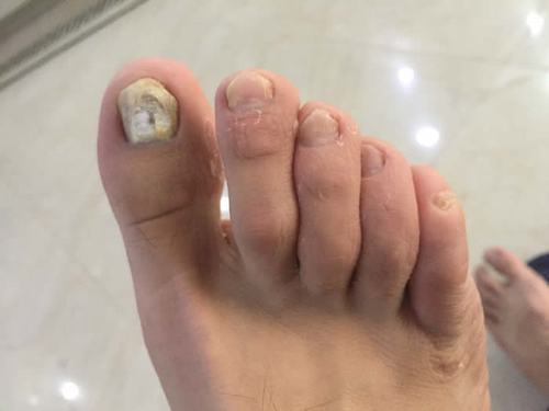 健康 正文 小刘说,他刚开始就一个脚趾甲有灰指甲,还是上学的时候没