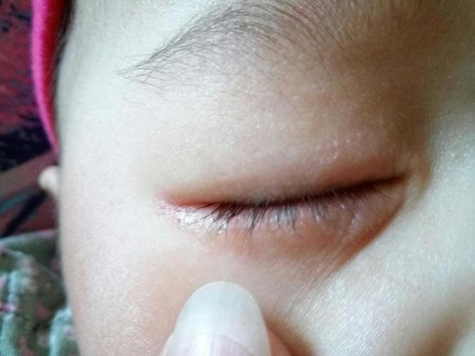 宝宝眼睛下面发红,有一块一块的像蜕皮一样的东西