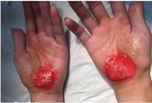 学生被磨破的手掌上面涂了红药水
