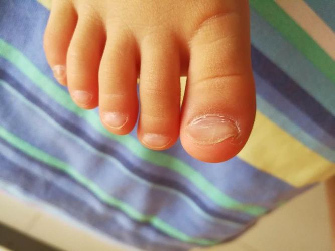 3岁宝宝大脚趾甲中间凹陷发白是什么原因