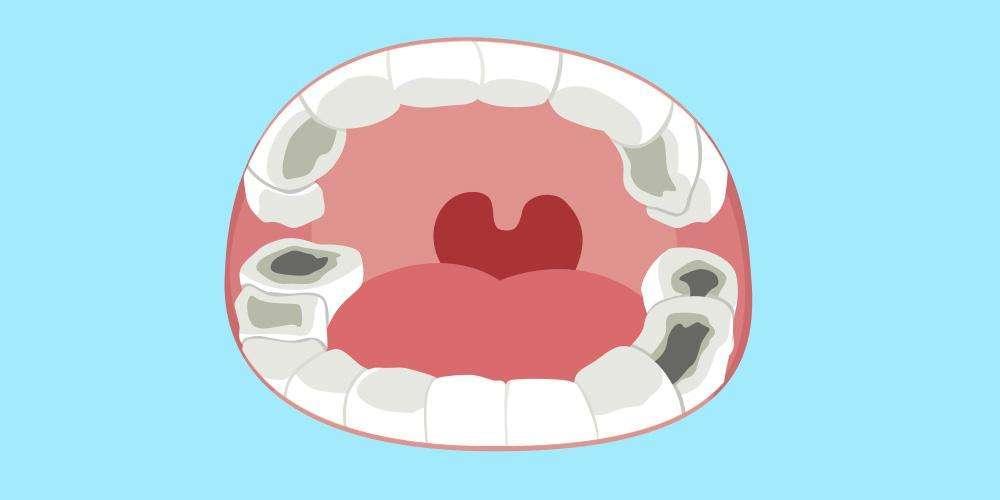 蛀牙更加通俗的描述就是在牙齿上出现了小洞,大洞,甚至大面积的牙体