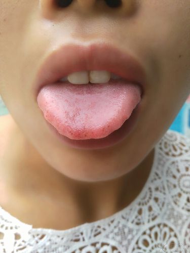 舌头尖位置有许多的小黑点是什么病的症状?