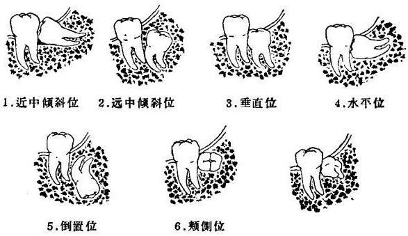 图解七种阻生牙(图)