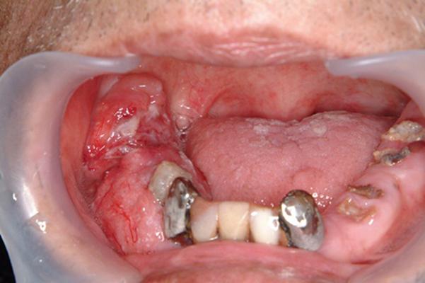 舌癌的初早期症状图片