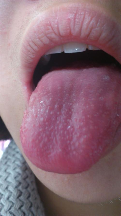 就像整个舌头都是透明的小颗粒,但主要是在舌尖