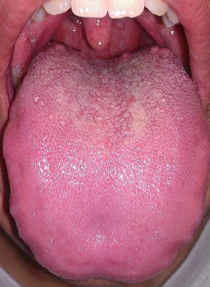 舌根起泡嗓子很痒起泡有两个多月了本来以为是咽炎上火引起的