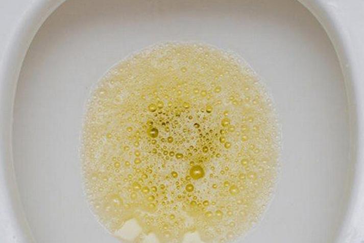 糖尿图正常的泡沫尿图如果尿液表面漂浮着一层细小的泡沫,且久久不散