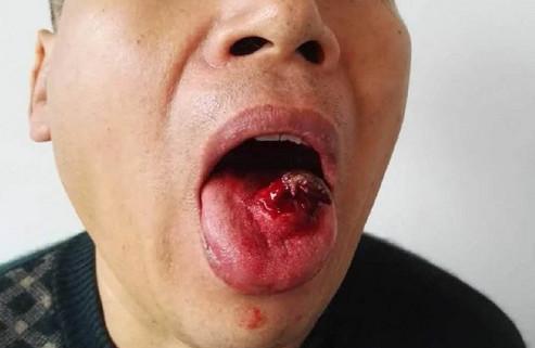 患舌癌割舌头,都是槟榔惹的祸?这些人也要随时当心!