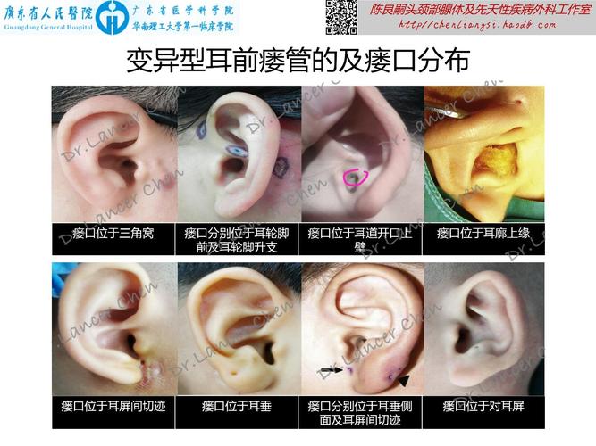 变异型        变异型耳前瘘管的瘘口多分布于此连线后方,最常见者