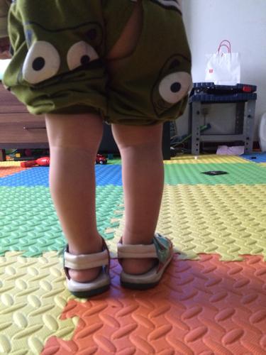 2014-02-25 汤旭毅 医师 宝宝一岁五个月o型腿,扁平足,现在查出有佝偻