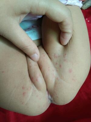 宝贝14个月,,用尿不湿,最近屁屁起了一些红痘痘,怎麼回事,一直用的