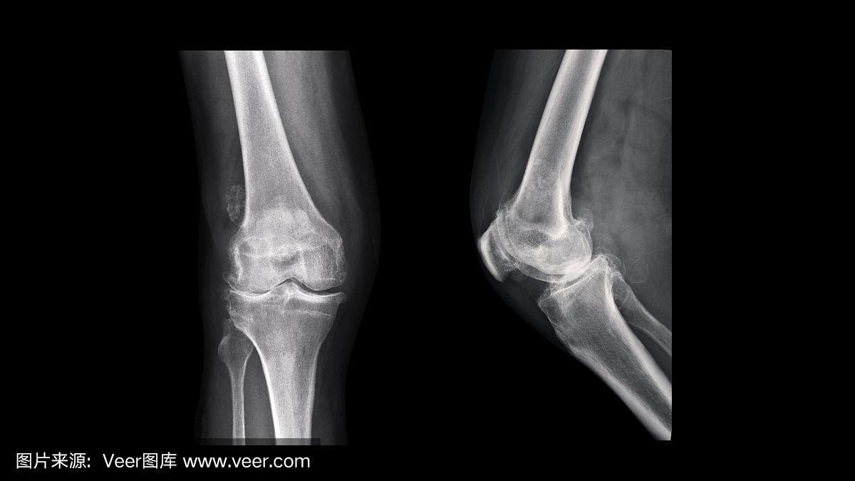 膝关节x线片显示类风湿关节炎(ra膝关节疾病)伴外翻畸形(膝外翻或膝
