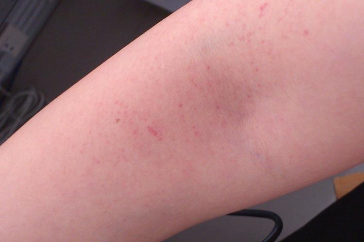 过敏性紫癜过敏性紫癜早期通常表现为红斑,斑疹或荨麻疹性