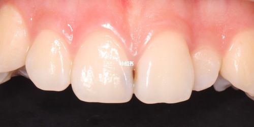 病例184  门牙蛀牙了?#前牙树脂美学修